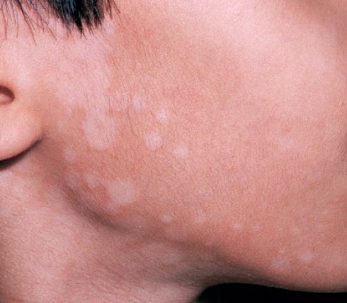 Sự thật về lang ben ở tuổi dậy thì